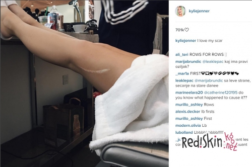 Кайли Дженнер показала большой шрам на ноге