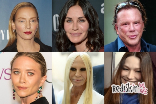 Знаменитости, утратившие свою красоту из-за пластики