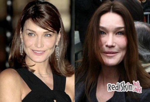 Знаменитости, утратившие свою красоту из-за пластики