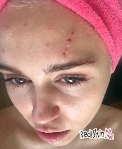 Майли Сайрус показала исцарапанное лицо, руку и голову