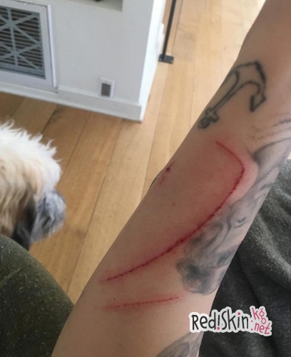 Майли Сайрус показала исцарапанное лицо, руку и голову